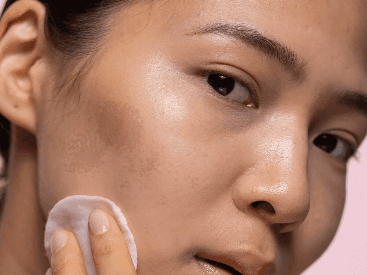 PDRN treatment for skin pigmentation