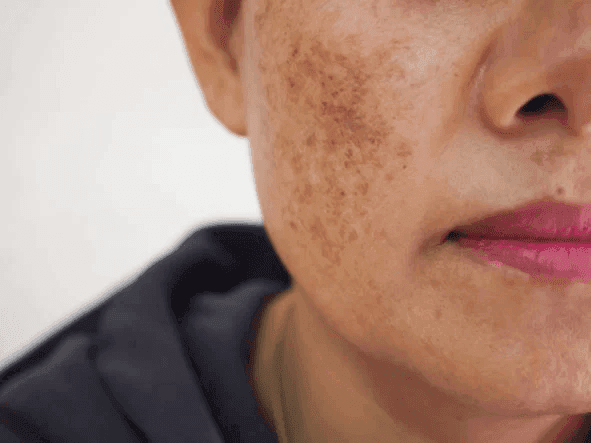 PDRN treatment for hyperpigmentation and skin brightening